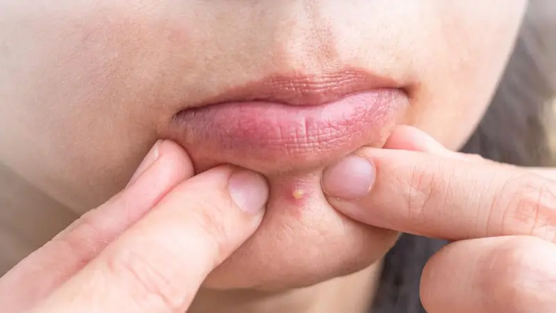 Brufoli Alimentari: Come Distinguere l'Acne e Cosa Mangiare